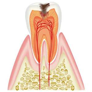 C2：象牙質に達した虫歯