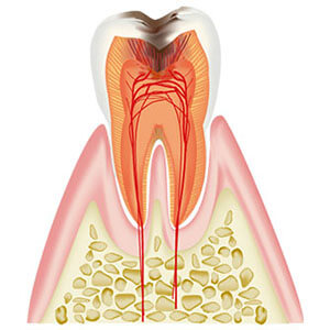 C3：歯髄（神経)に達した虫歯
