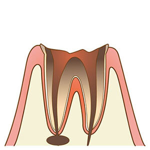 C4：歯質が失われた虫歯