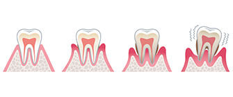 歯周病で抜歯をするケースとは？